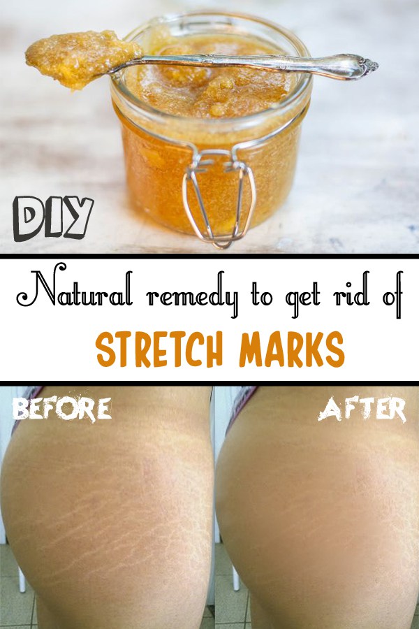 Natural remedy to get rid of stretch marks 1