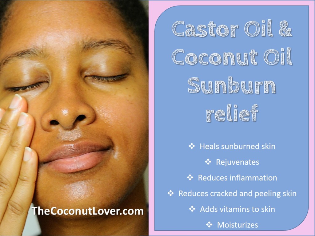 Coconut oil sunburn 